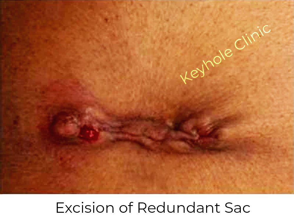 Figure 2:  Excision of Redundant Sac - Initial Laparoscopy -  Presentation of laparoscopy followed by open