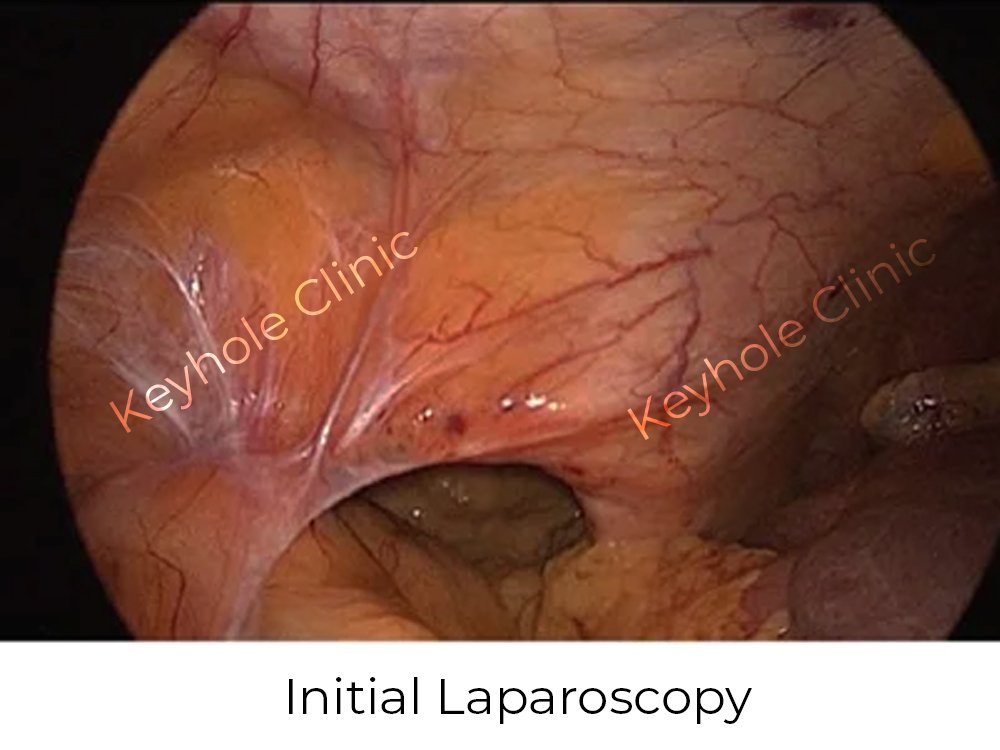 Figure 3:  Initial Laparoscopy - Presentation of laparoscopy followed by open surgery and again laparoscopy at last