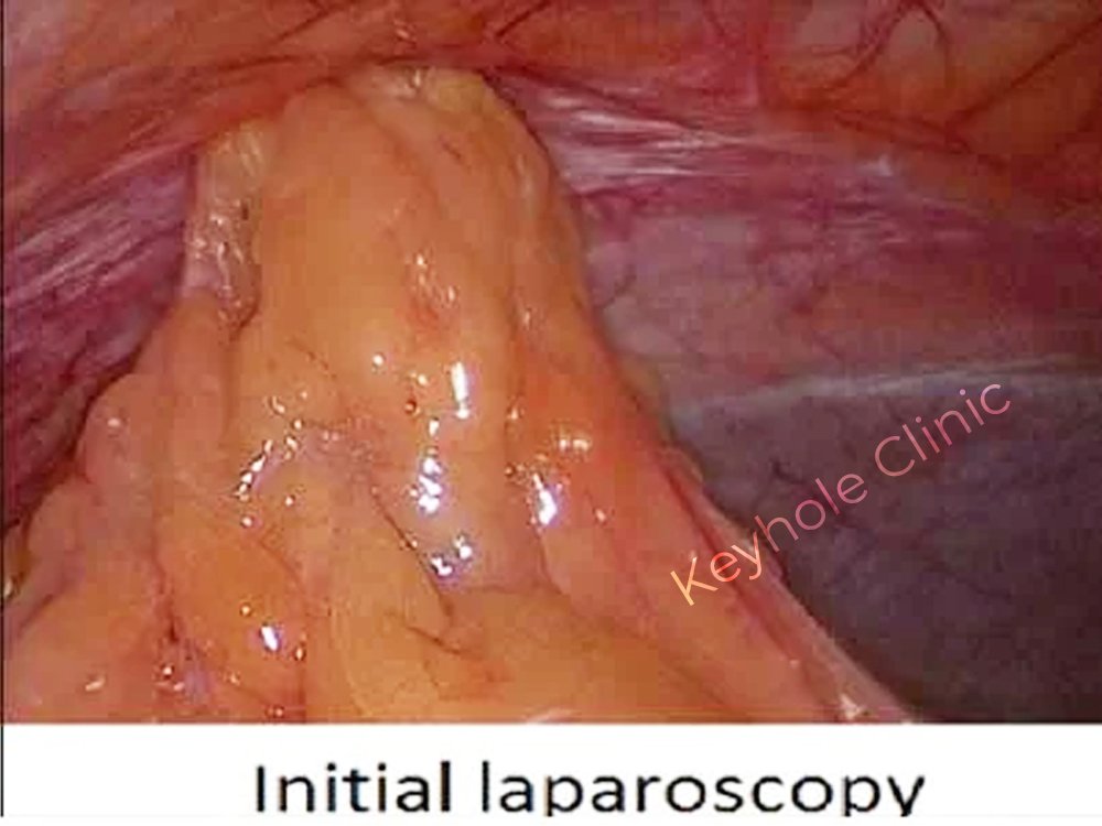 Figure 2: Initial Laparoscopy -  Presentation of laparoscopy followed by open