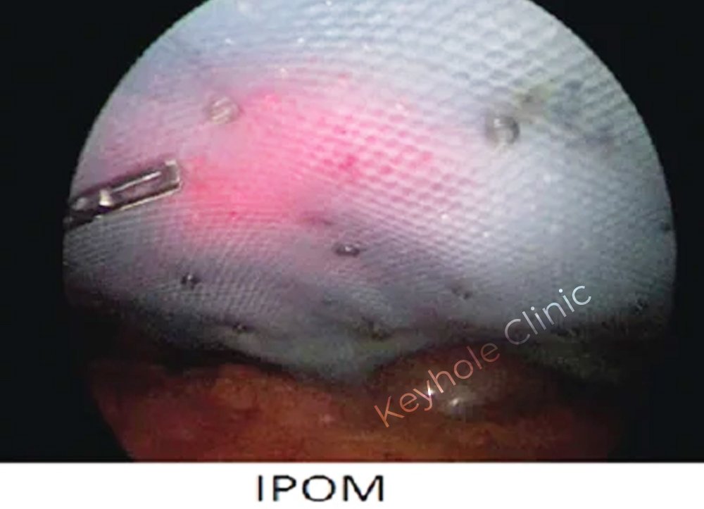 Figure 1: IPOM- Presentation of open surgery followed by laparoscopy and open surgery again at last.