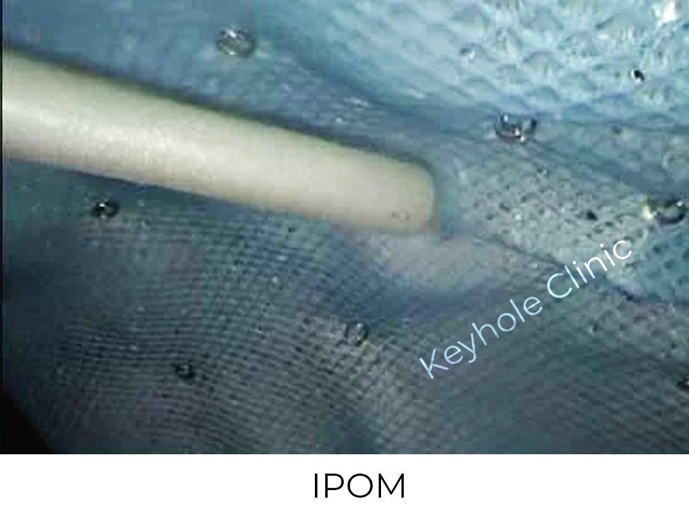 Figure 2: IPOM - Initial Laparoscopy -  Presentation of laparoscopy followed by open