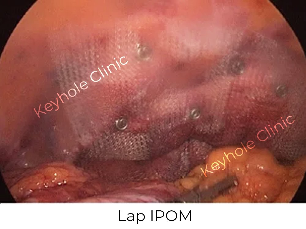 Figure 3: Lap IPOM - Presentation of laparoscopy followed by open surgery and again laparoscopy at last
