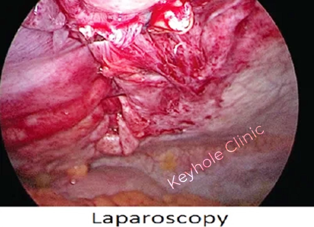Figure 1: Laparoscopy - Presentation of open surgery followed by laparoscopy and open surgery again at last.  