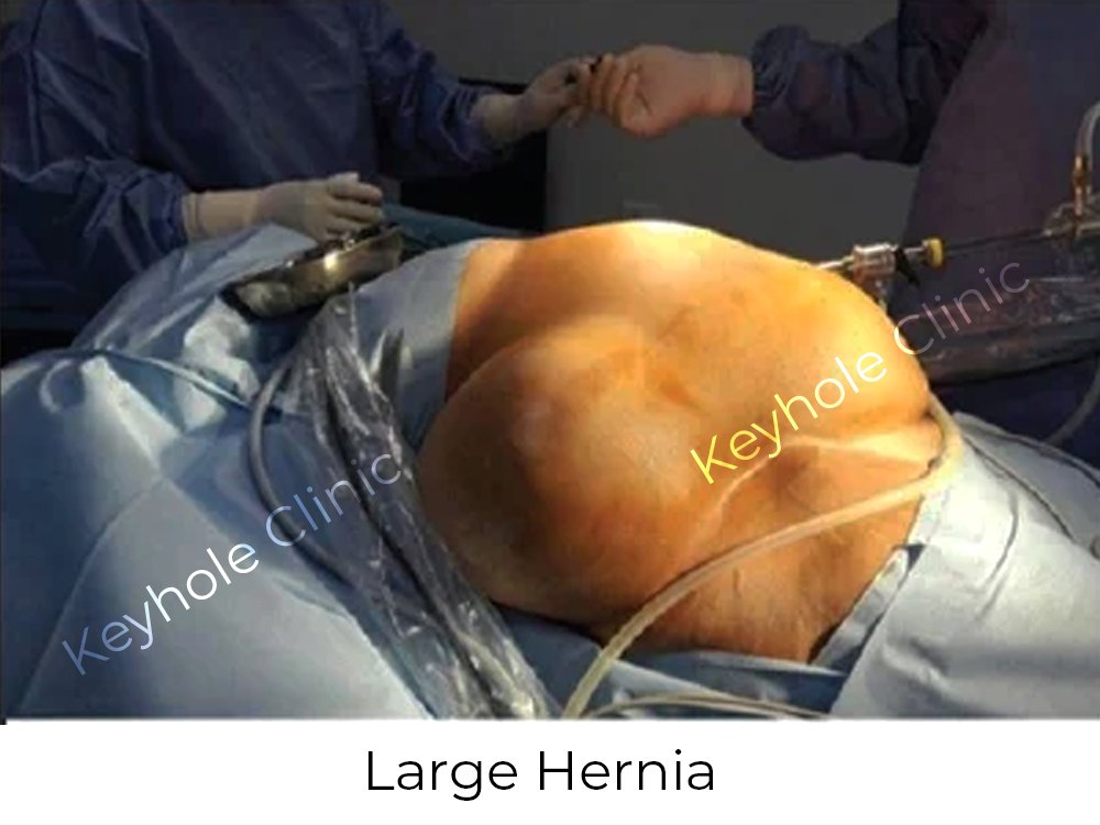 Figure 3:  Large Hernia - Presentation of laparoscopy followed by open surgery and again laparoscopy at last