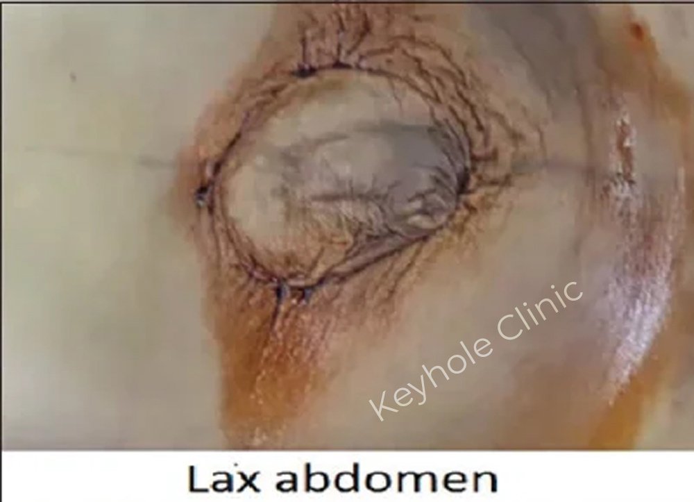 Figure 1: Presentation of open surgery followed by laparoscopy and open surgery again at last.  Lax Abdomen