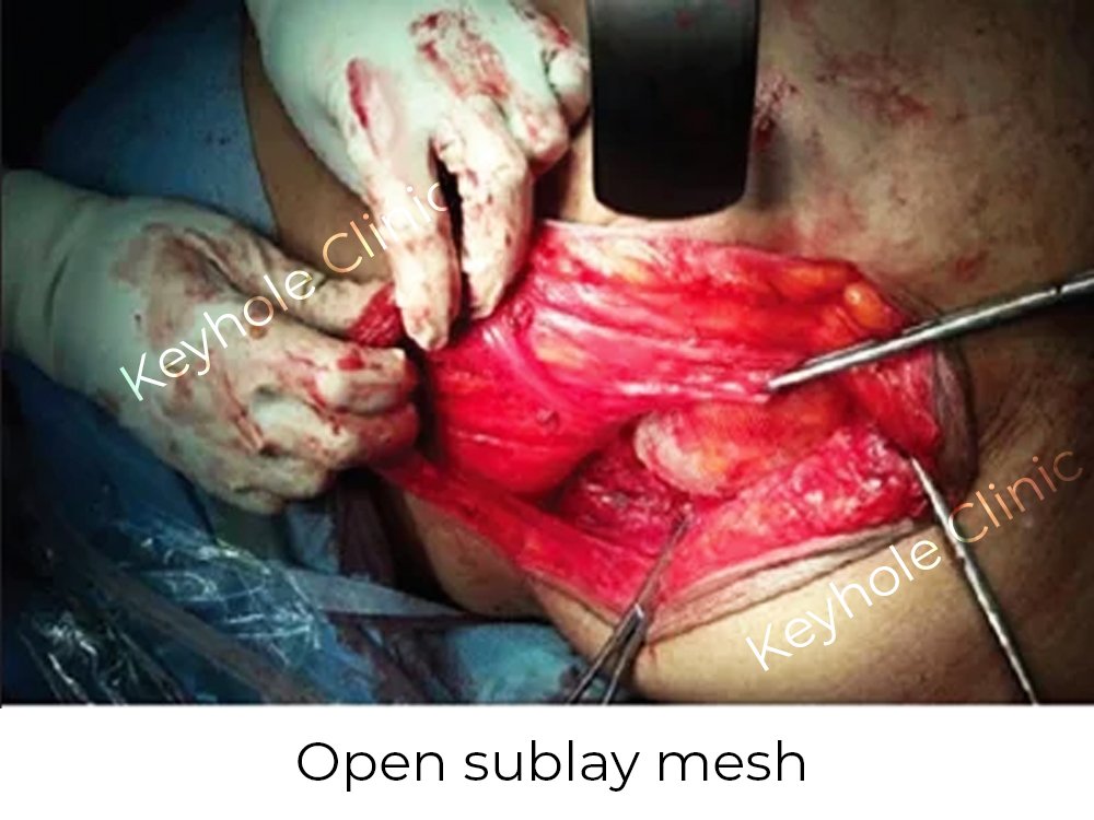 Figure 3:  Open sublay mesh - Presentation of laparoscopy followed by open surgery and again laparoscopy at last